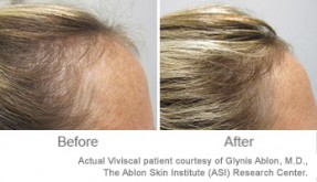 Zinc hair growth results