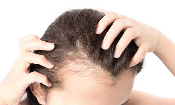 Hairline-woman-thinning-hair-checking-early-signs-baldness-viviscal-blog