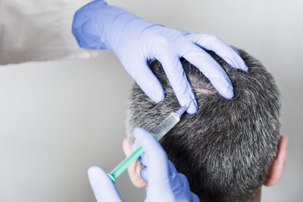 doctor injecting scalp man back male hair loss causes prevention viviscal hair blog